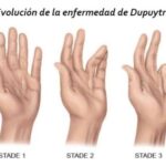 contractura de Dupuytren (3)