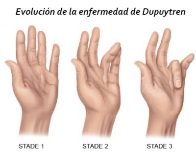 contractura de Dupuytren (3)